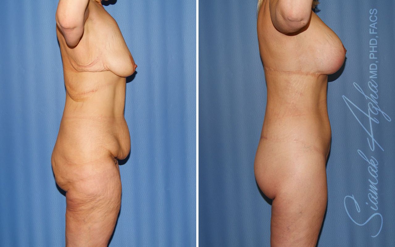 Total Body Lift Before & After