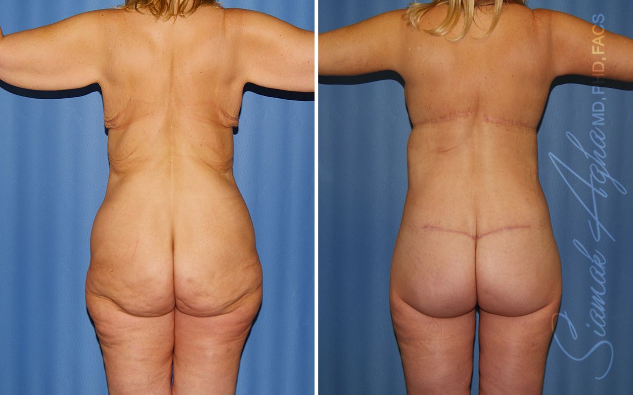 Total Body Lift Before & After