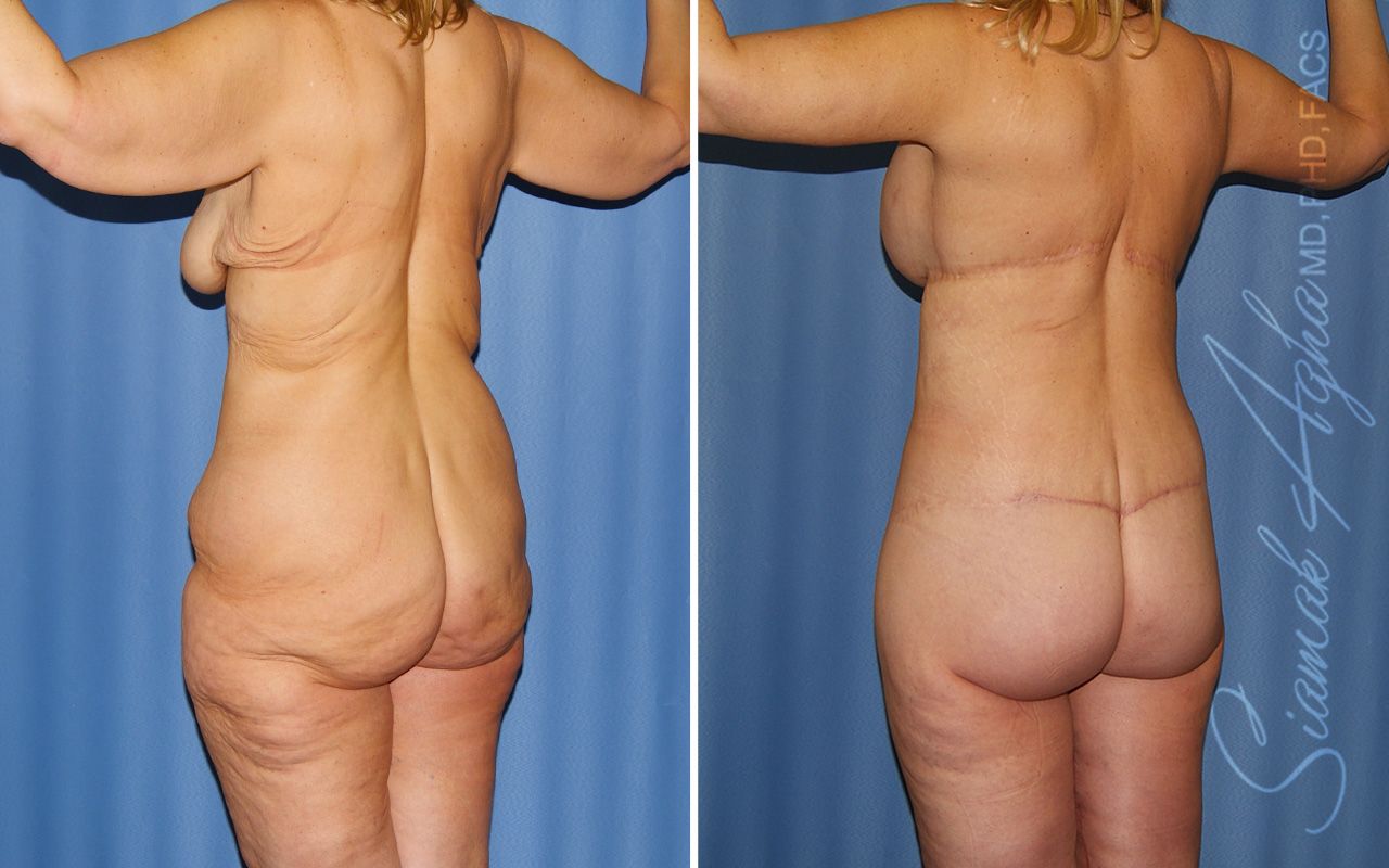 Total Body Lift Before & After