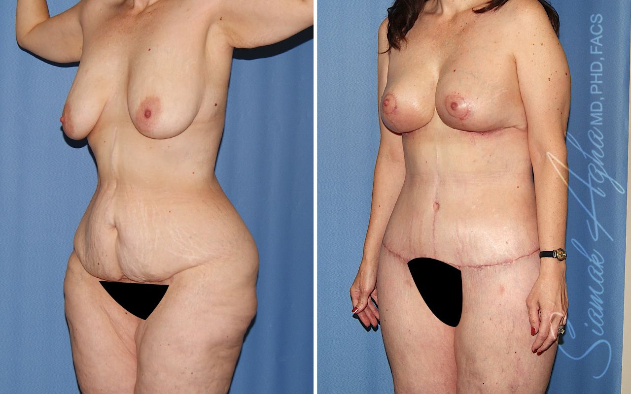 Total Body Lift Before & After