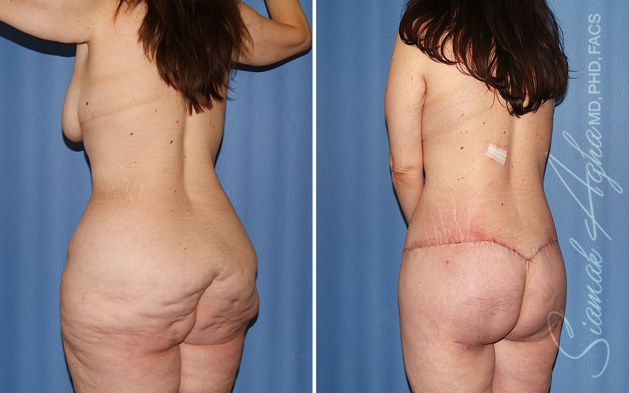 Total Body Lift Before & After