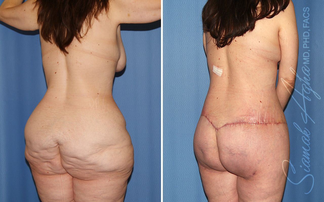 Total Body Lift Before & After