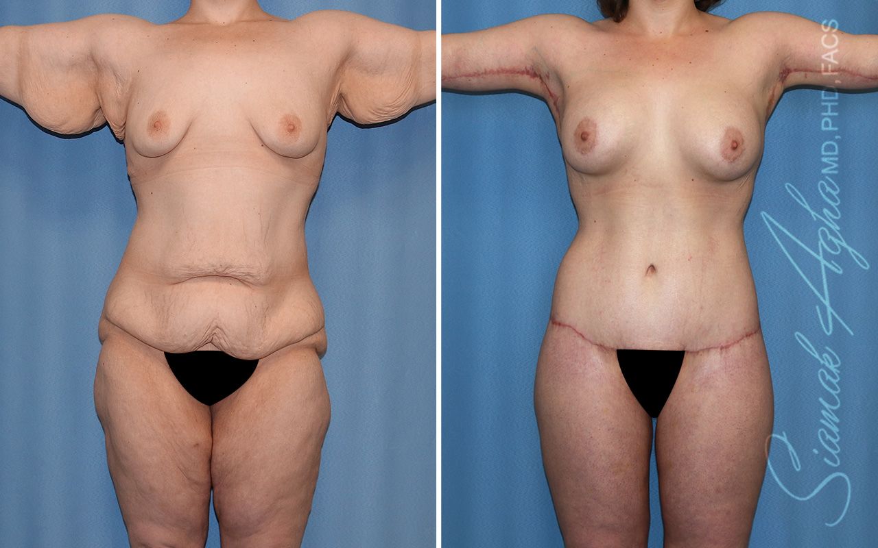 Total Body Lift Before & After