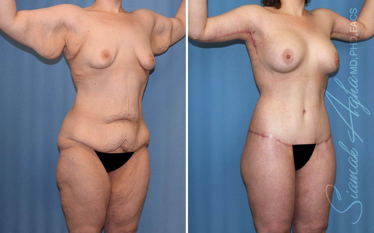 Total Body Lift Before & After