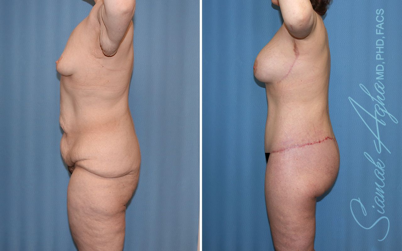 Total Body Lift Before & After