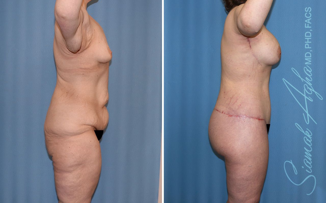Total Body Lift Before & After