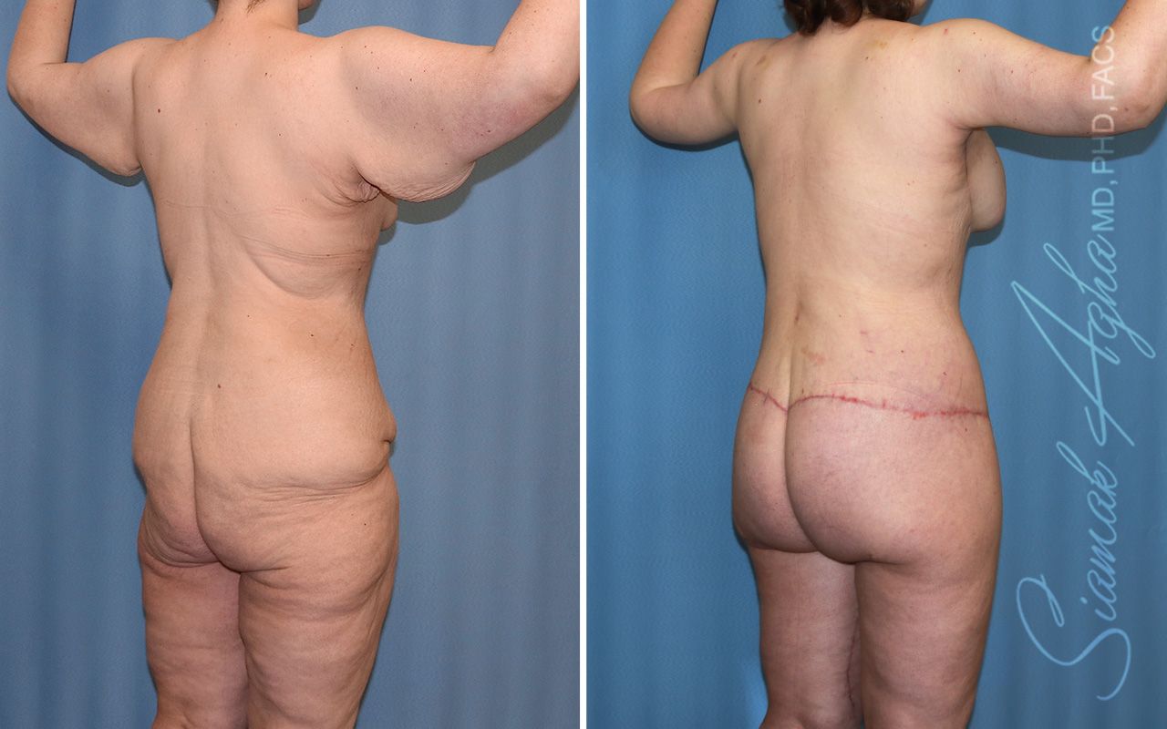 Total Body Lift Before & After