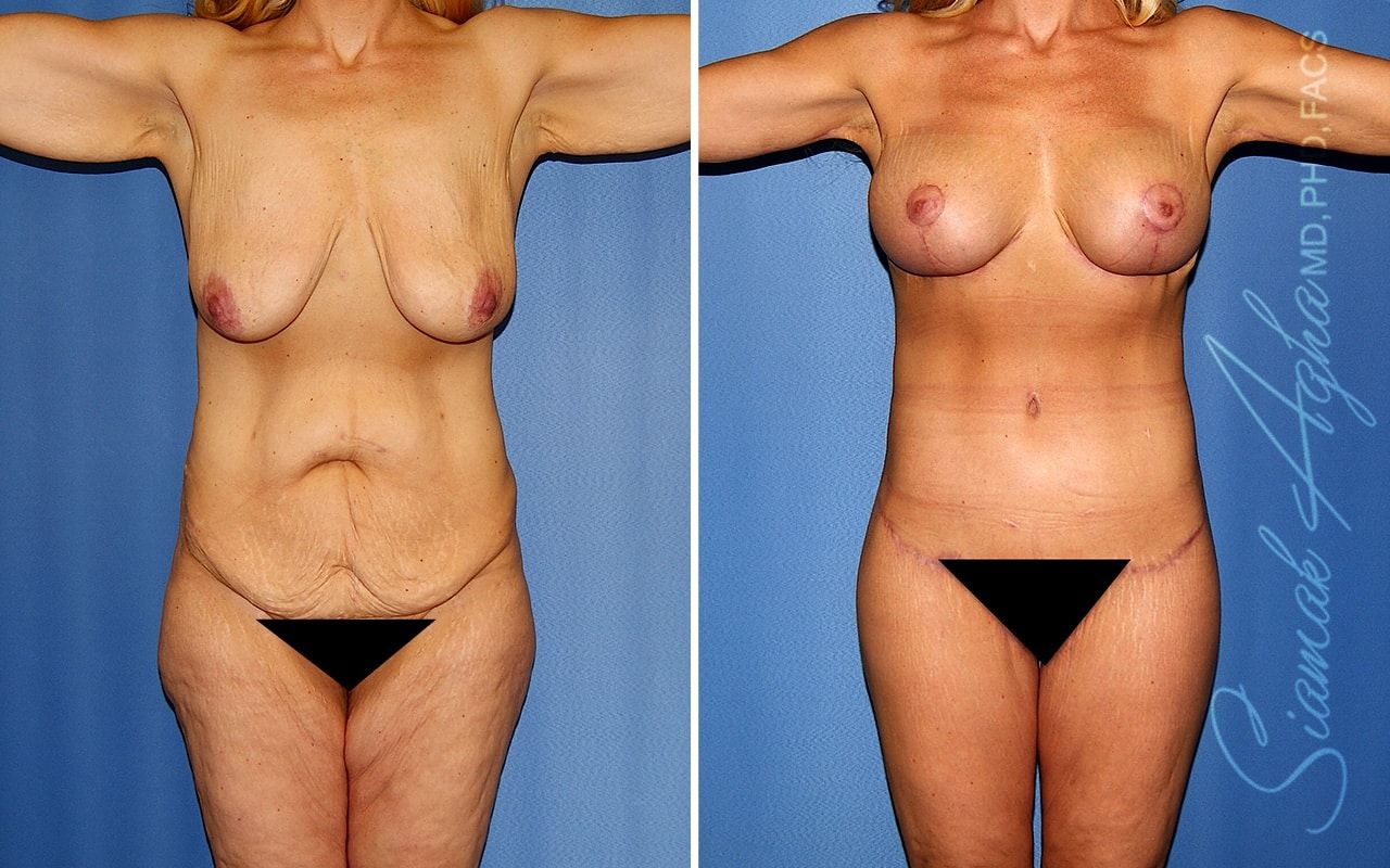 Total Body Lift Before & After