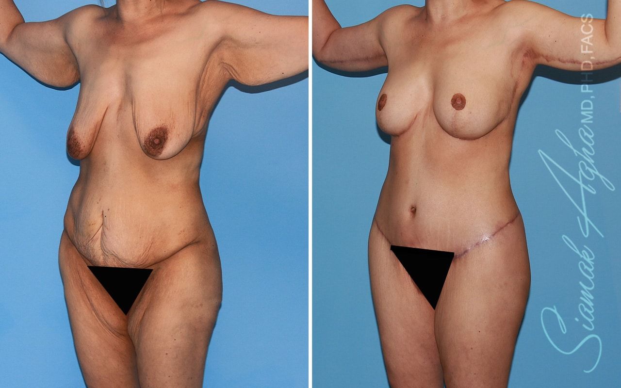 Total Body Lift Before & After