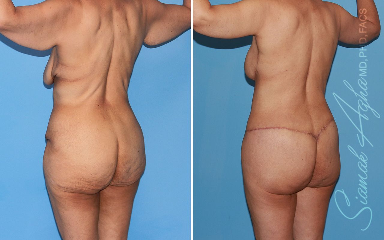 Total Body Lift Before & After