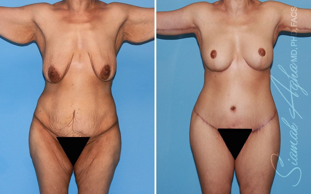 Total Body Lift Before & After