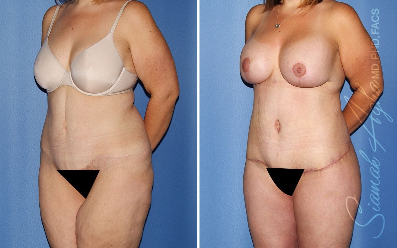 Total Body Lift Before & After