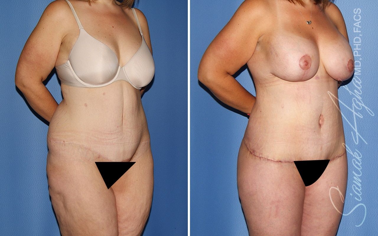 Total Body Lift Before & After