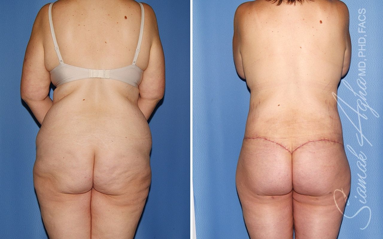 Total Body Lift Before & After