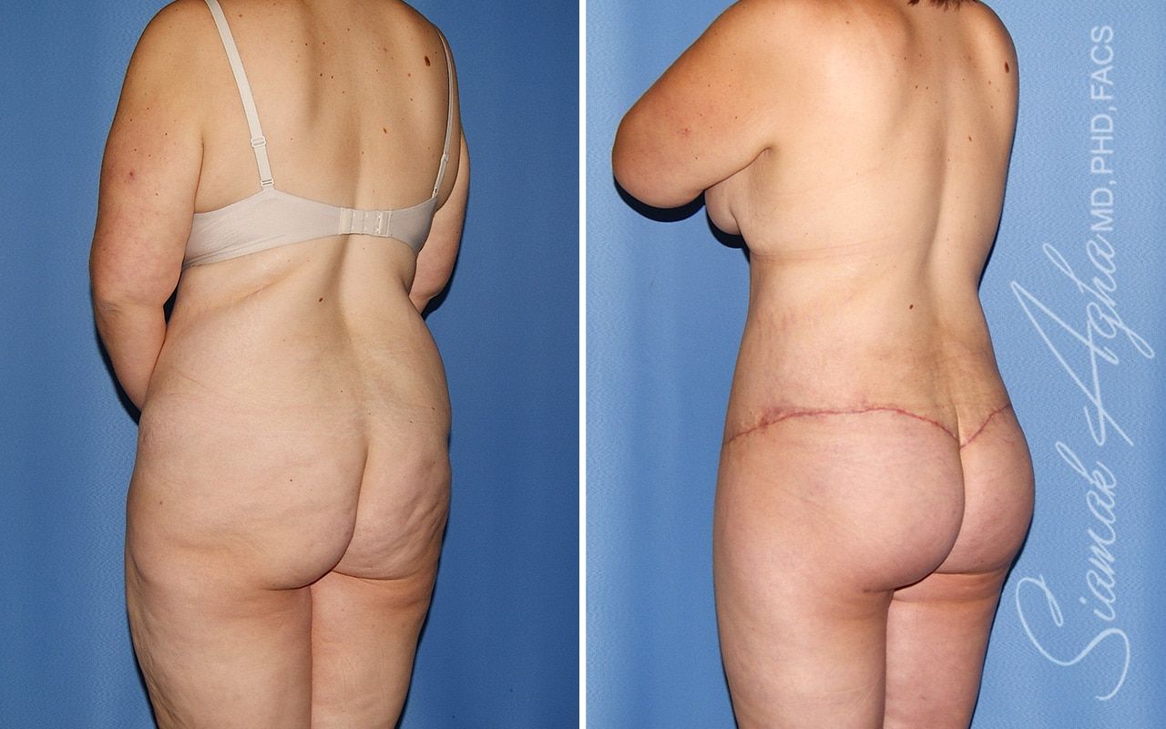 Total Body Lift Before & After