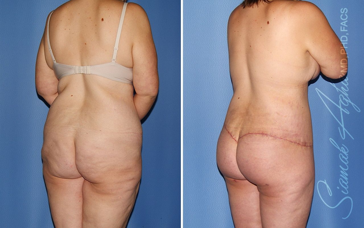 Total Body Lift Before & After