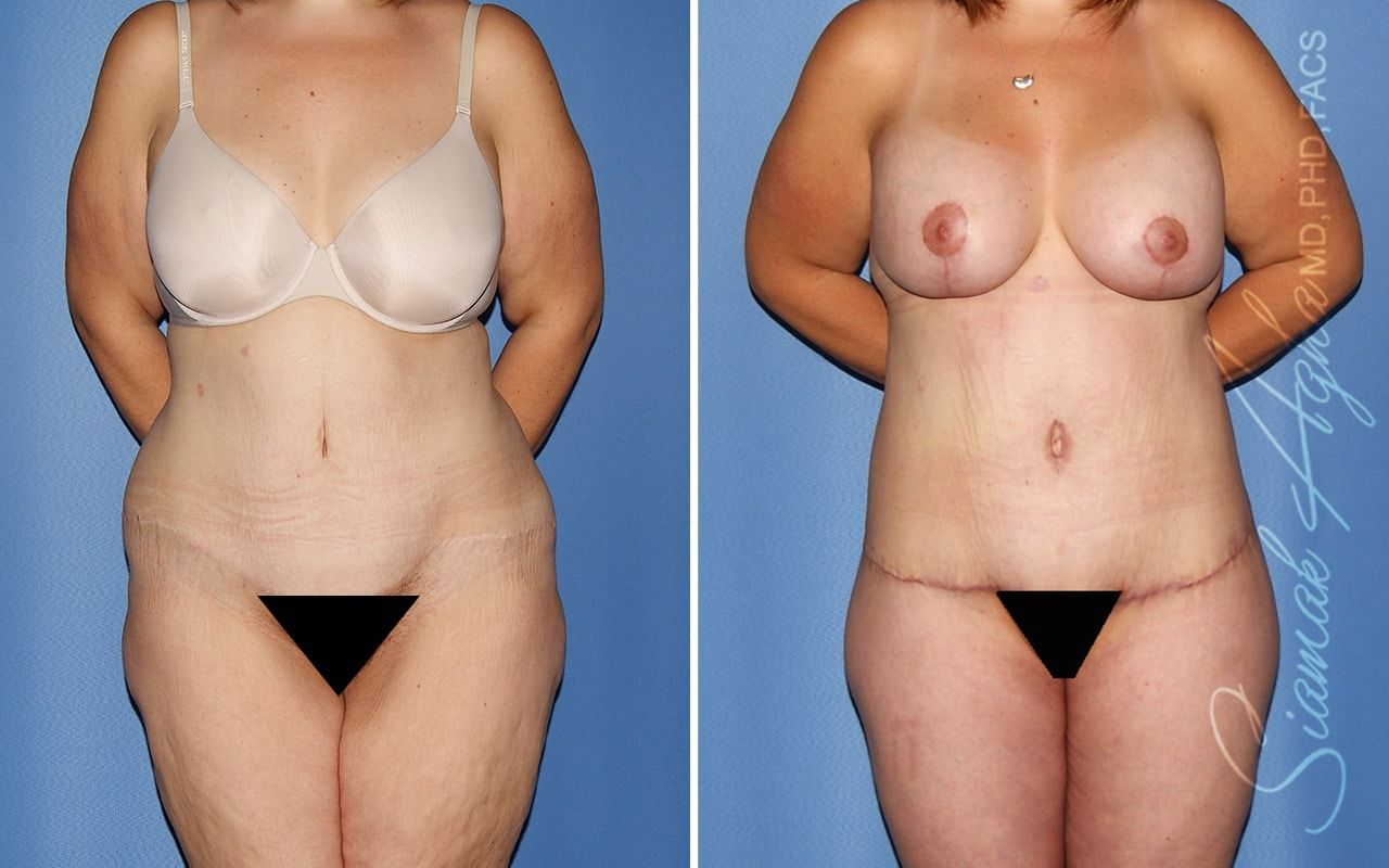 Total Body Lift Before & After