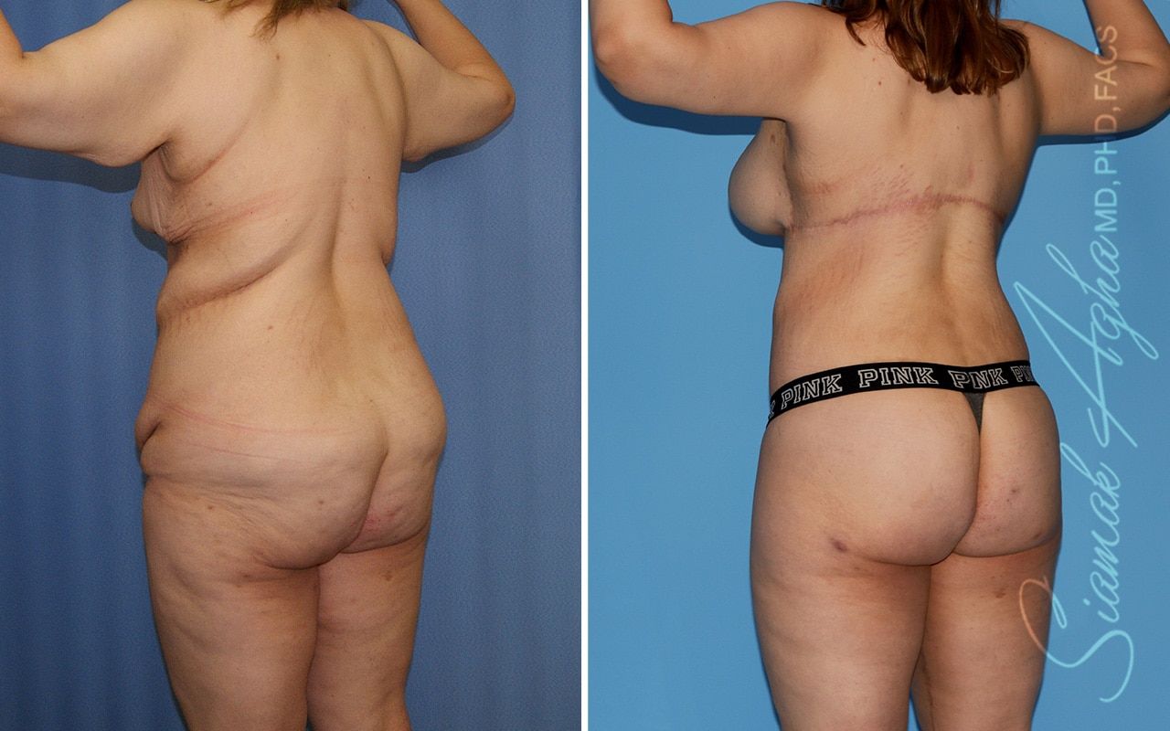 Total Body Lift Before & After