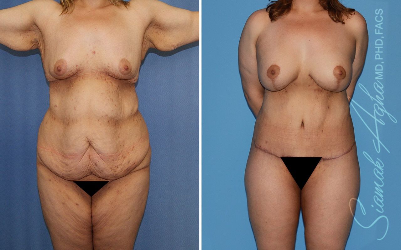 Total Body Lift Before & After