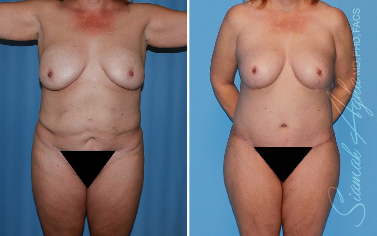 Total Body Lift Before & After