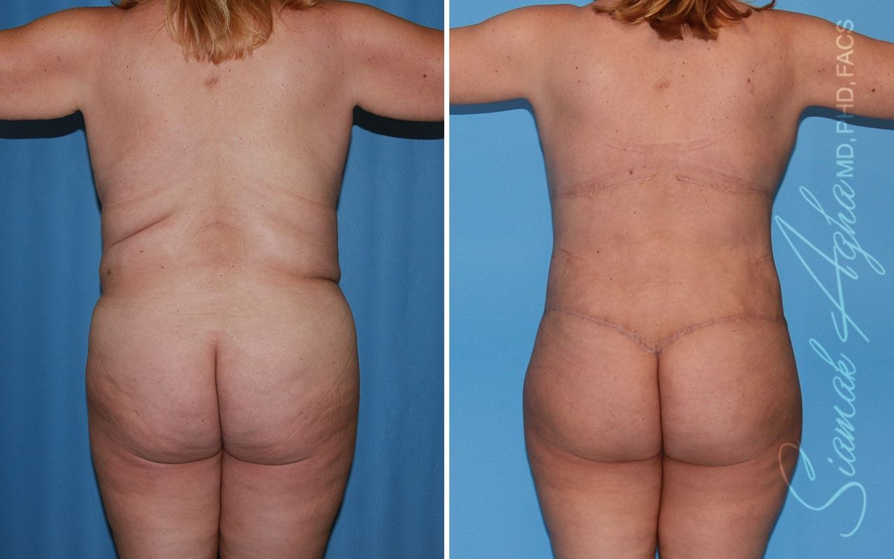 Total Body Lift Before & After