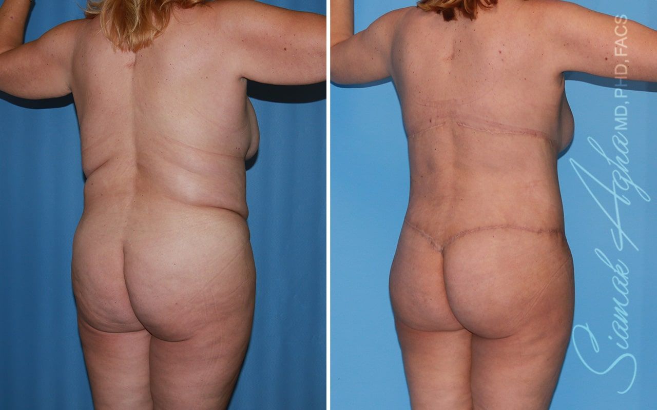 Total Body Lift Before & After