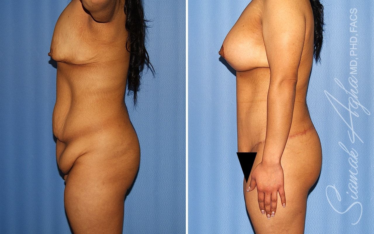 Total Body Lift Before & After