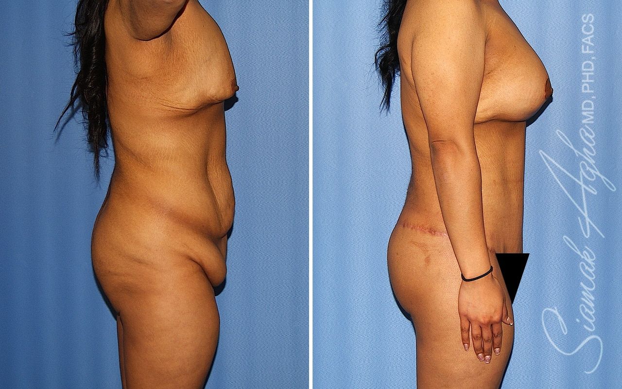 Total Body Lift Before & After