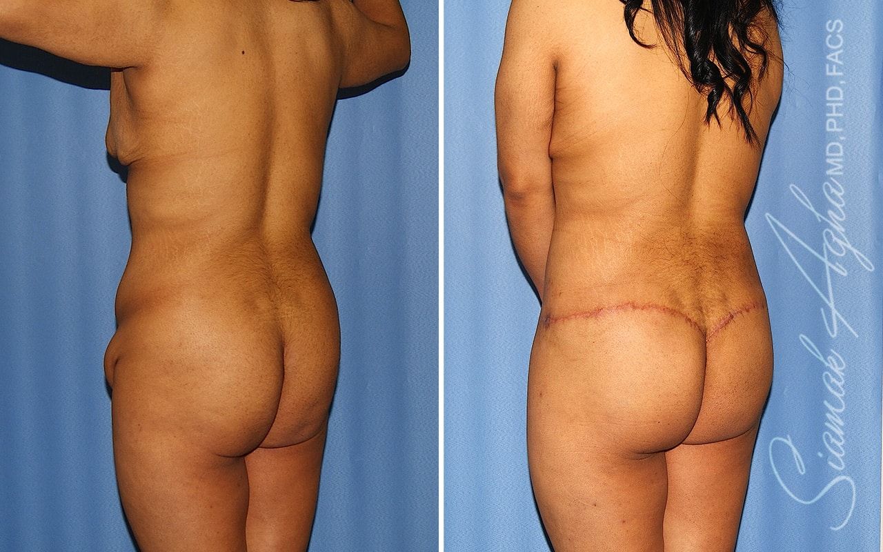 Total Body Lift Before & After