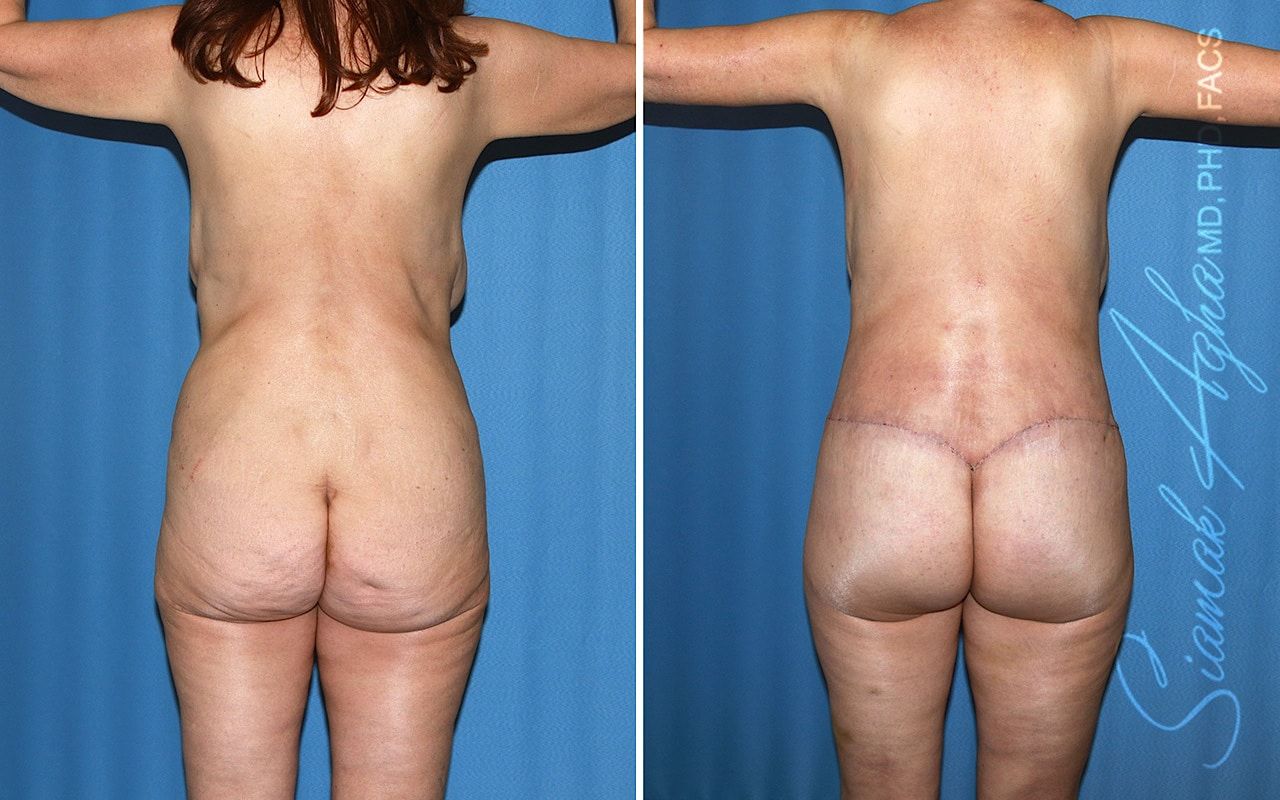 Total Body Lift Before & After