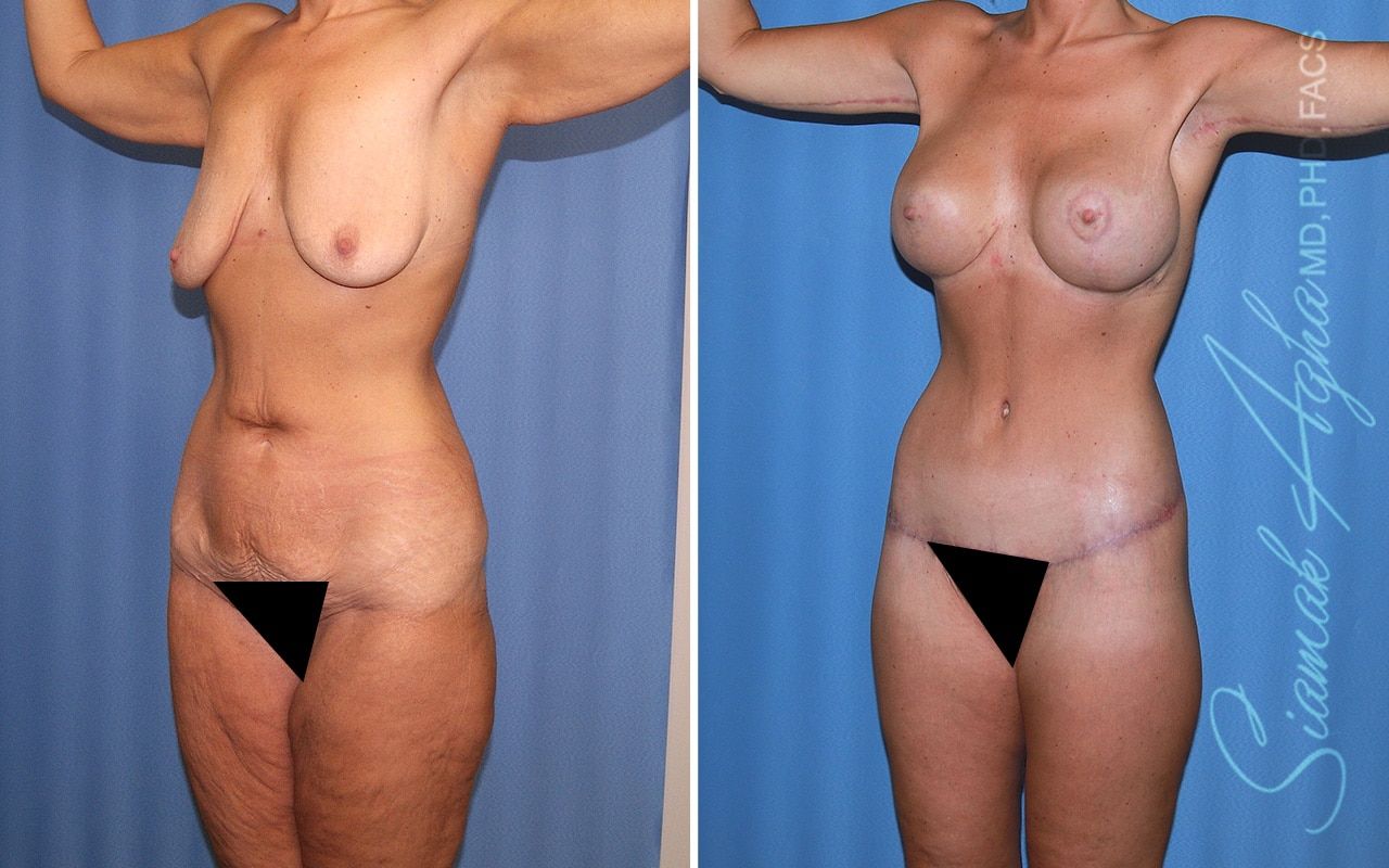 Total Body Lift Before & After