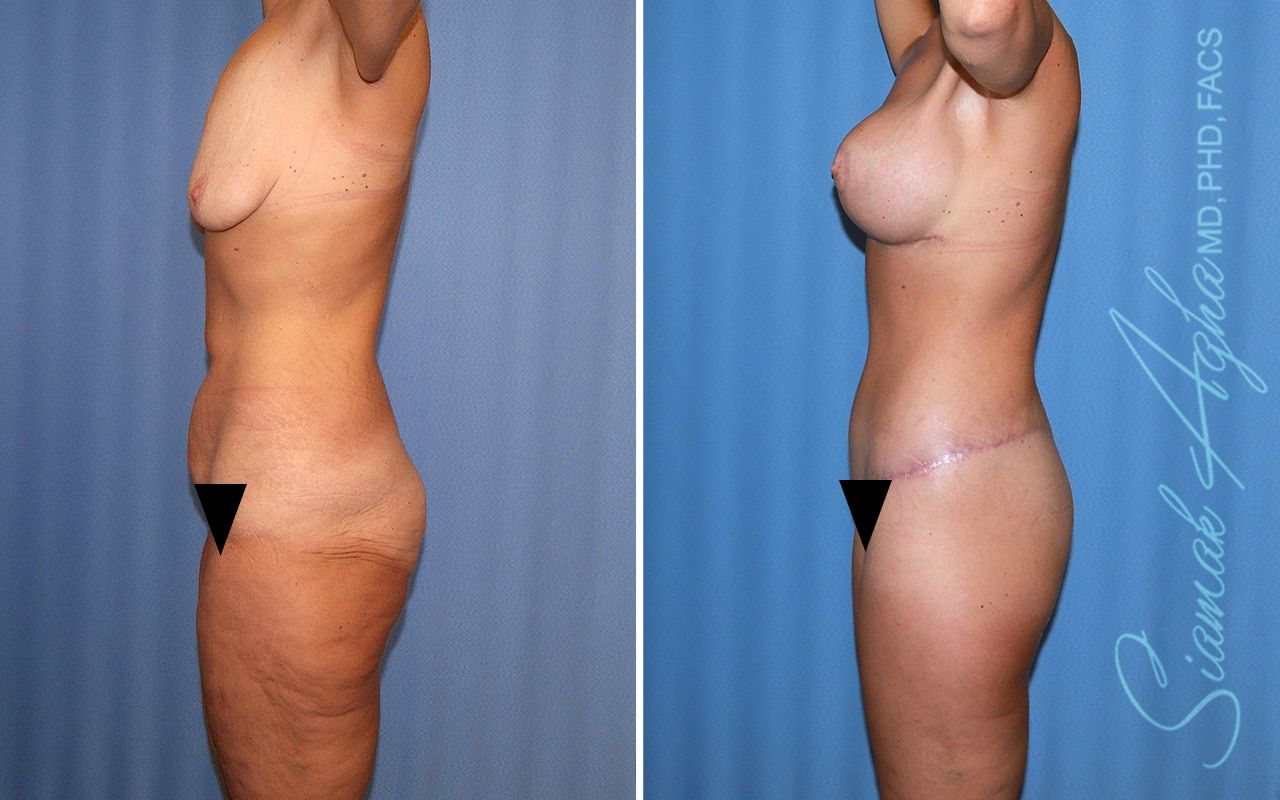 Total Body Lift Before & After