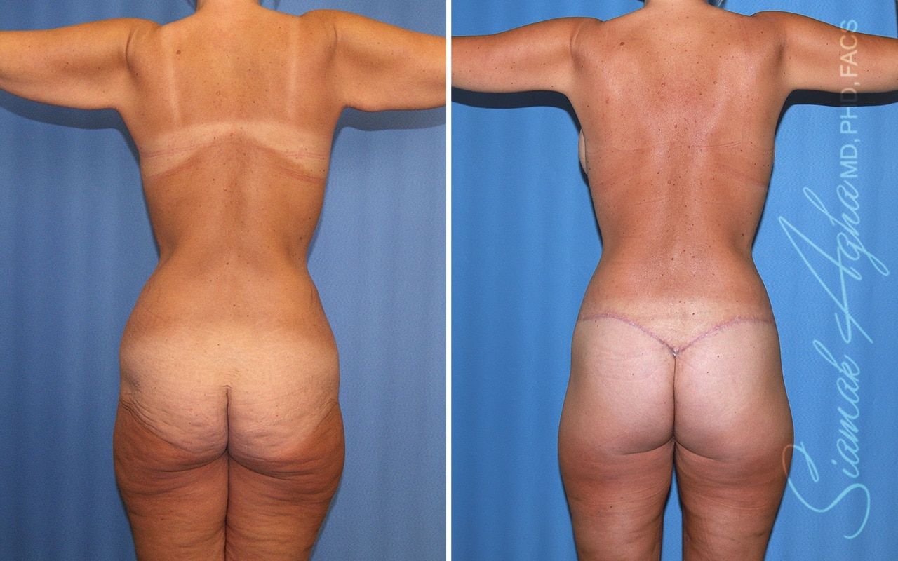 Total Body Lift Before & After