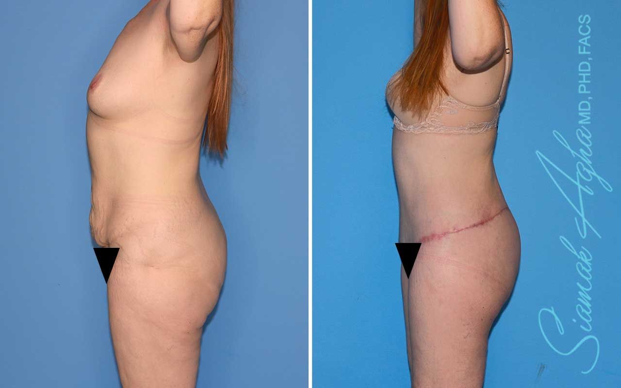 Total Body Lift Before & After