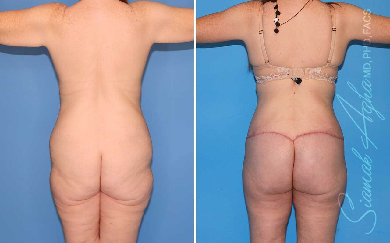 Total Body Lift Before & After