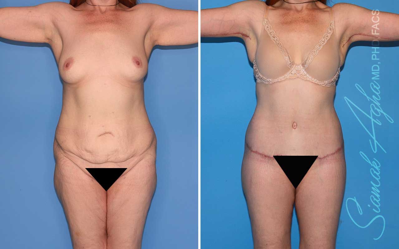 Total Body Lift Before & After