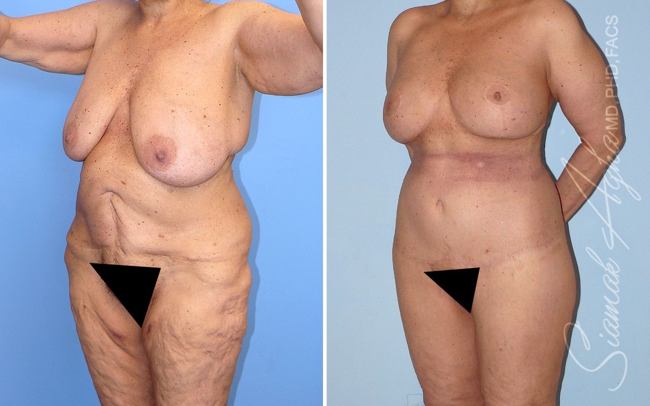 Total Body Lift Before & After