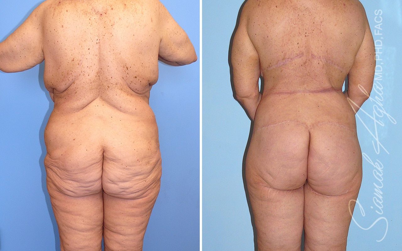 Total Body Lift Before & After