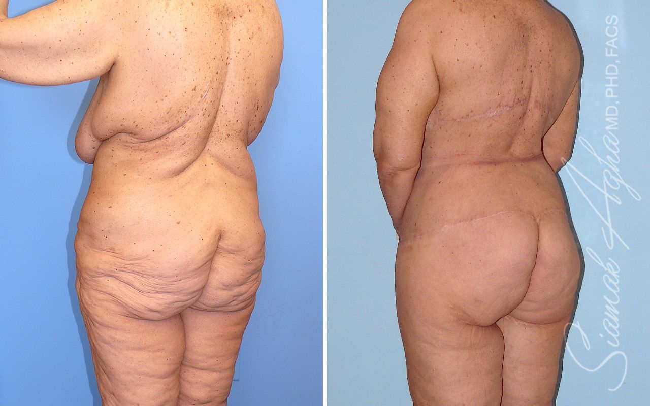 Total Body Lift Before & After