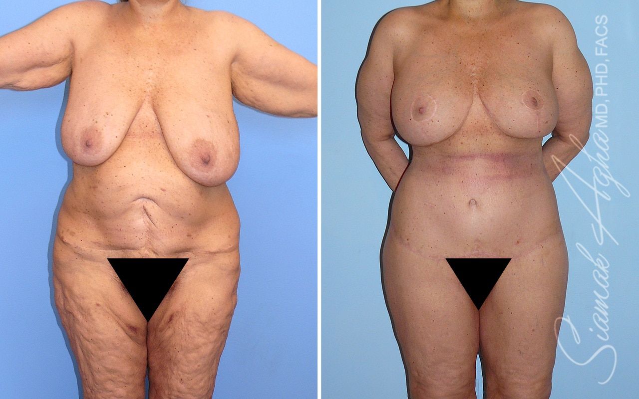 Total Body Lift Before & After