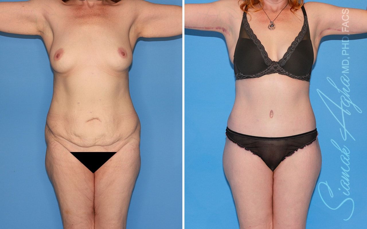 Total Body Lift Before & After