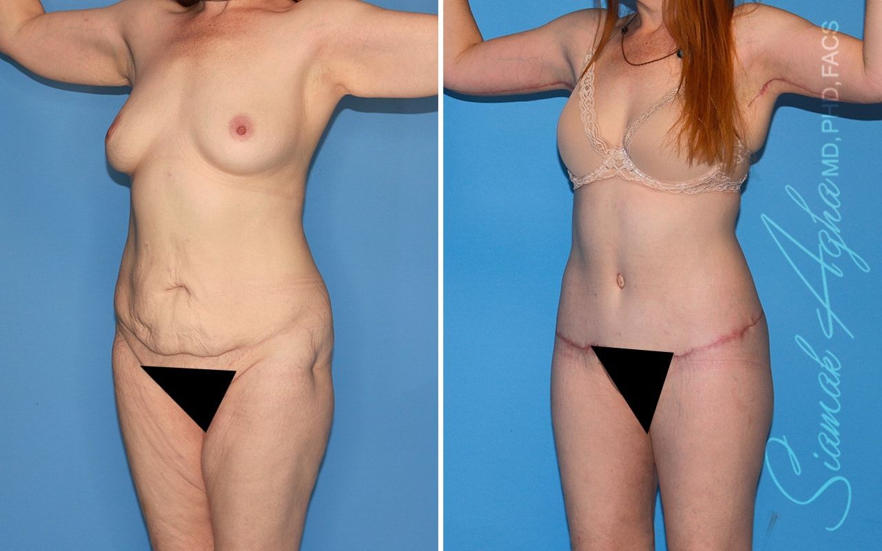 Total Body Lift Before & After