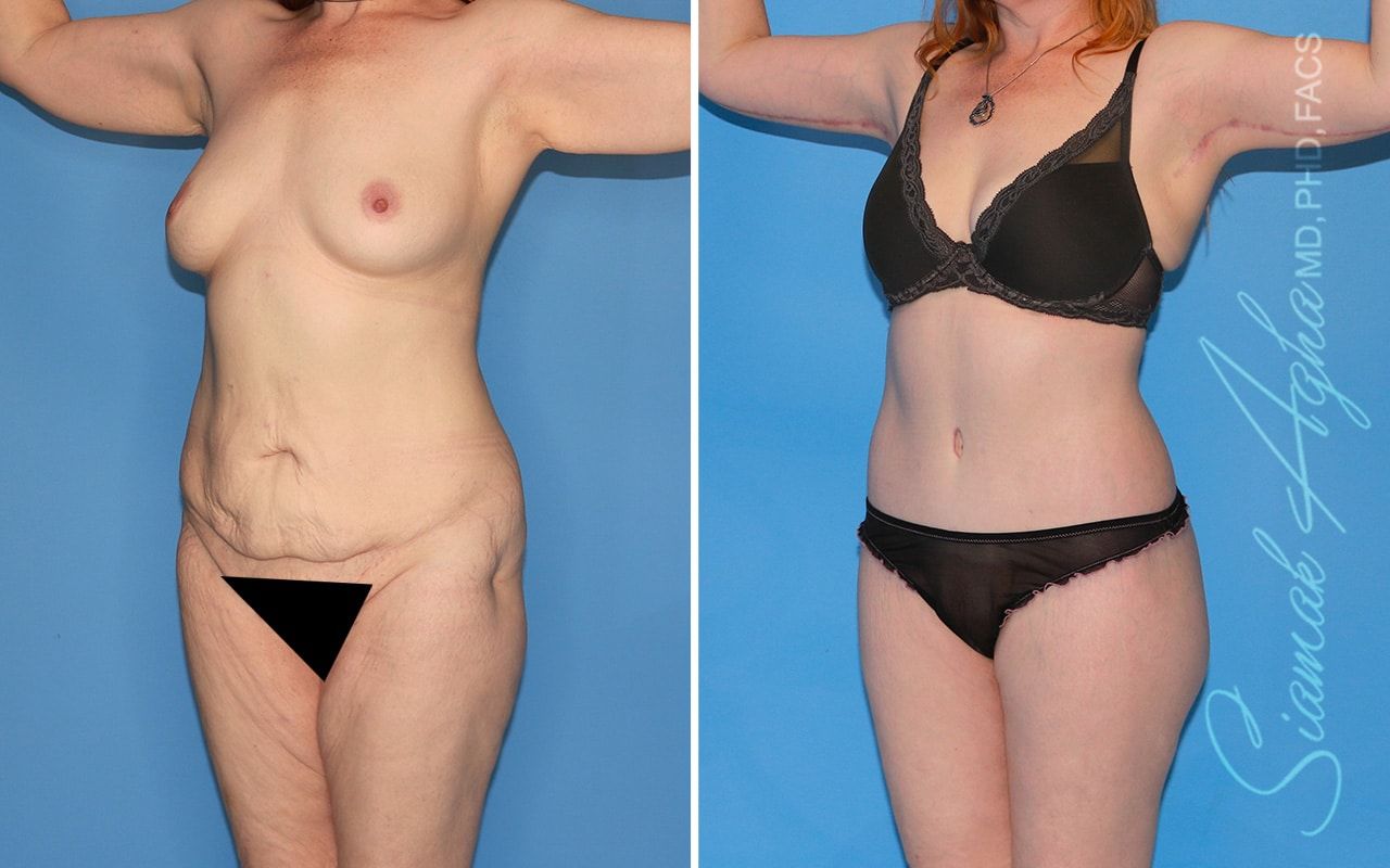 Total Body Lift Before & After