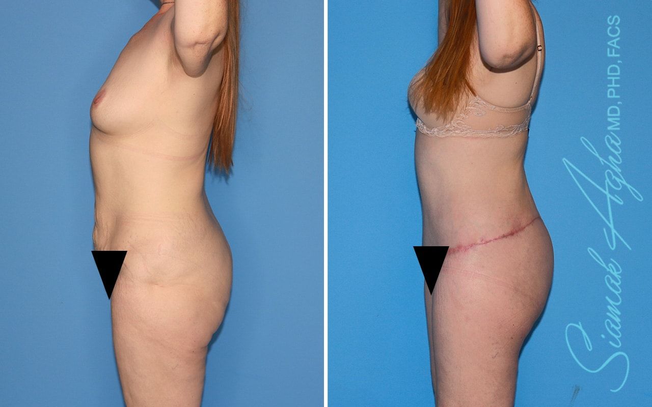 Total Body Lift Before & After
