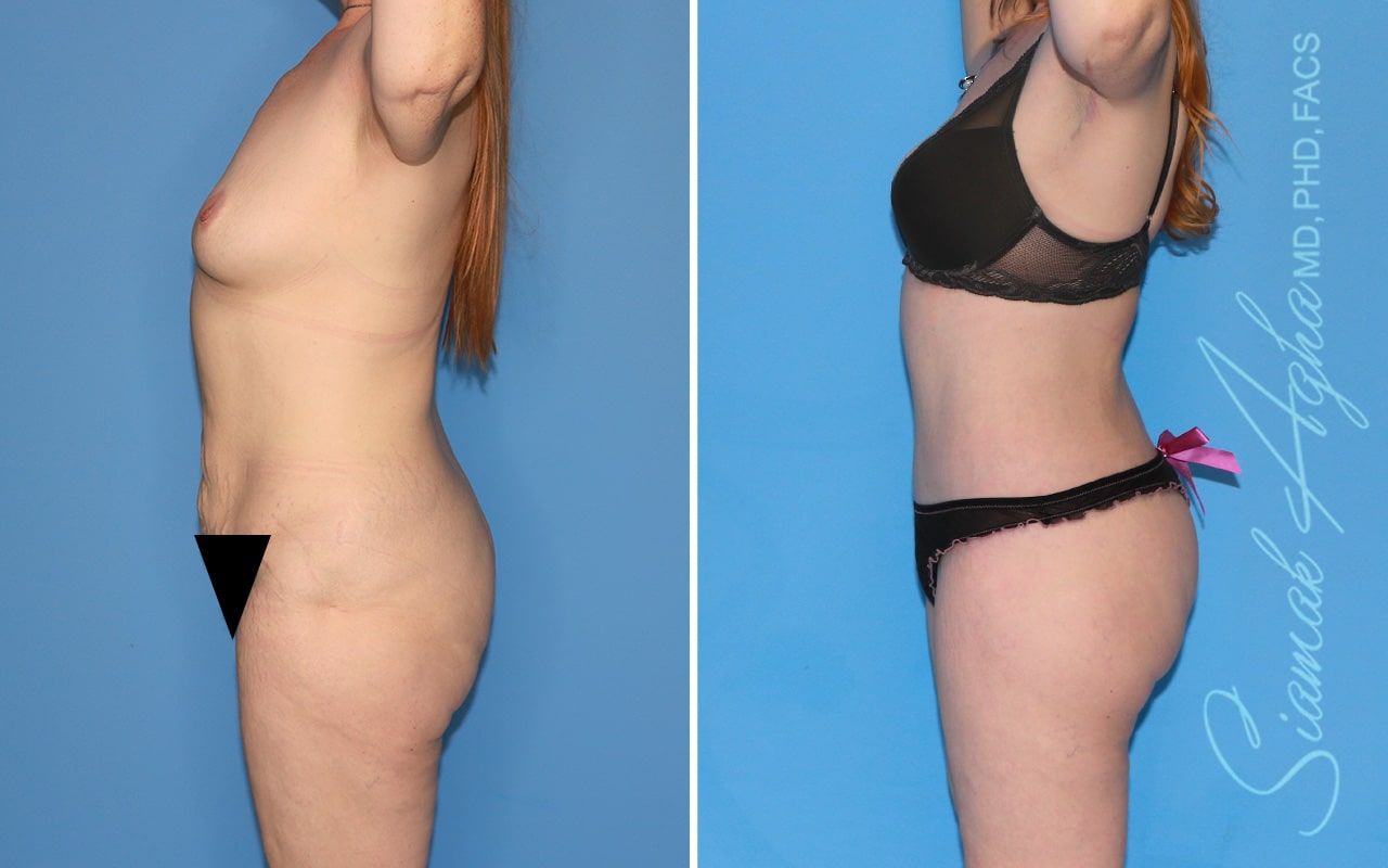 Total Body Lift Before & After