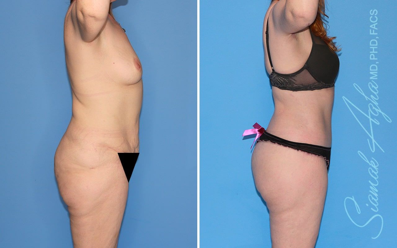 Total Body Lift Before & After