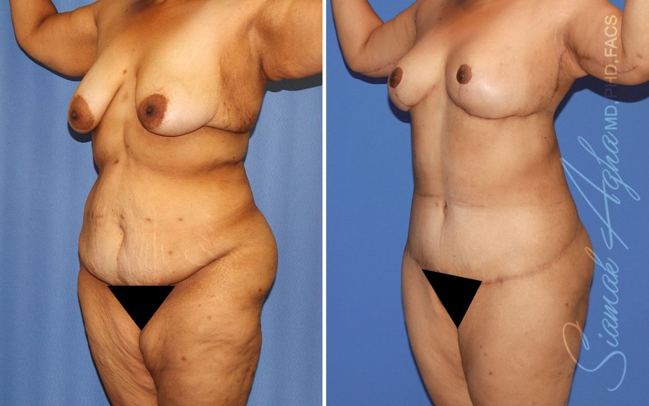 Total Body Lift Before & After