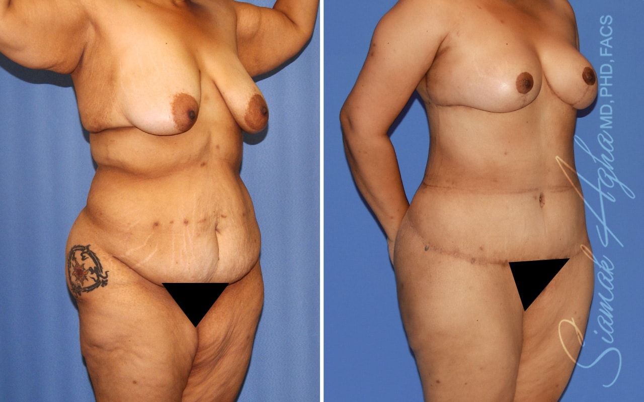 Total Body Lift Before & After
