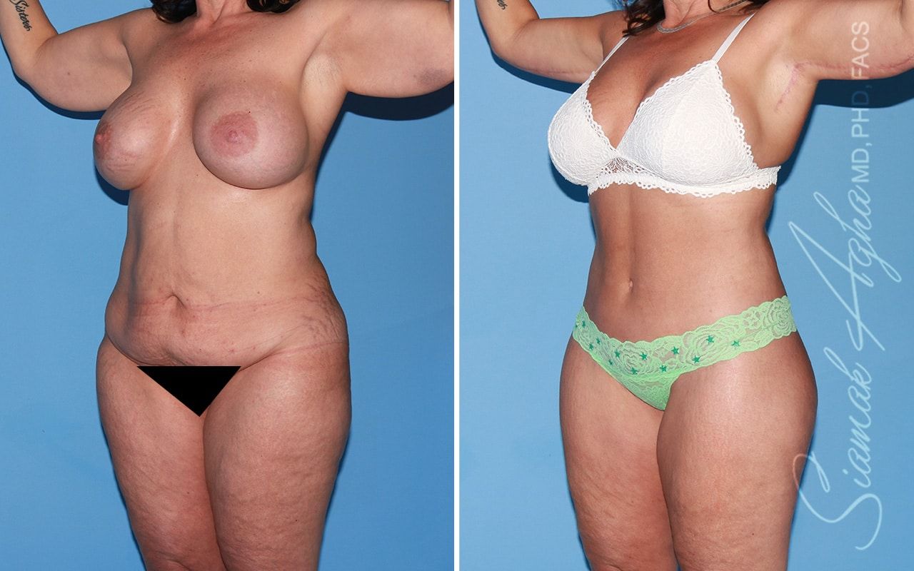 Total Body Lift Before & After