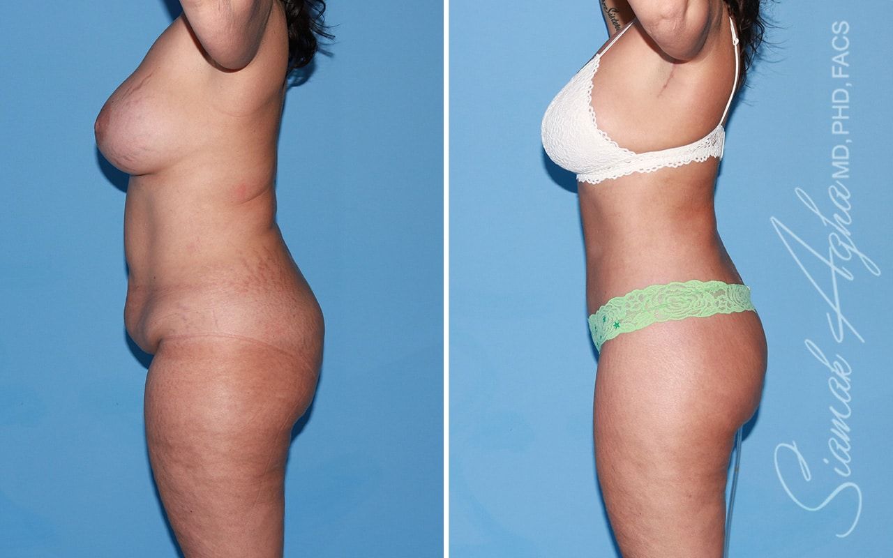 Total Body Lift Before & After